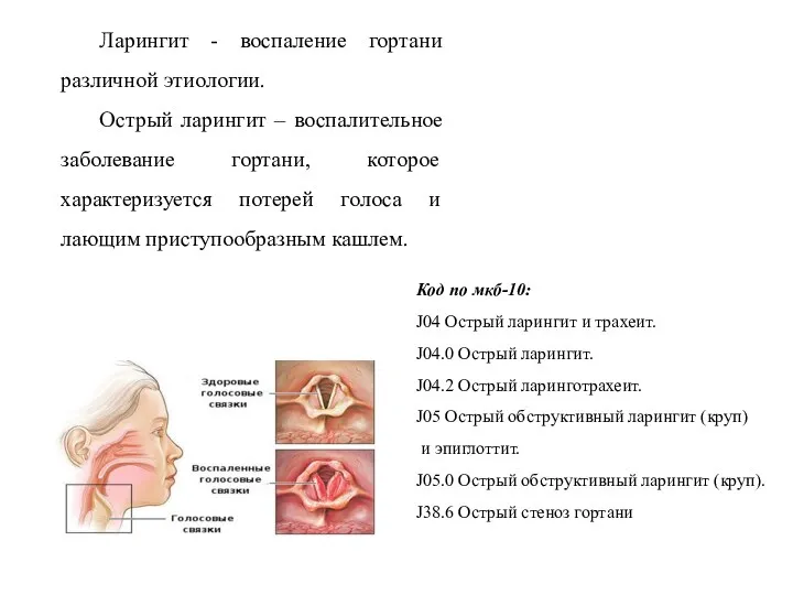 Ларингит - воспаление гортани различной этиологии. Острый ларингит – воспалительное