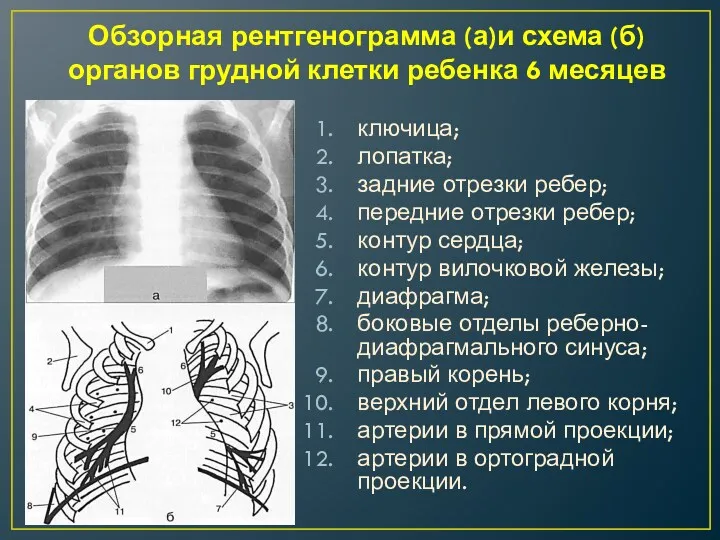 Обзорная рентгенограмма (а)и схема (б) органов грудной клетки ребенка 6