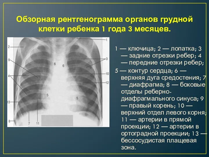 Обзорная рентгенограмма органов грудной клетки ребенка 1 года 3 месяцев.