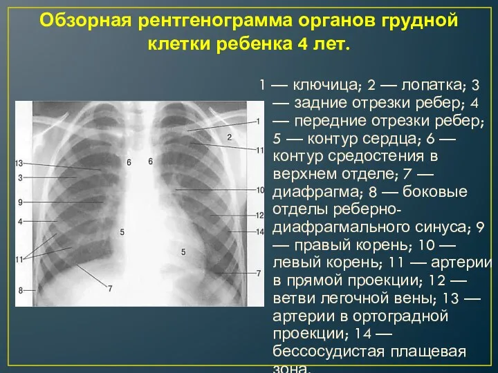 Обзорная рентгенограмма органов грудной клетки ребенка 4 лет. 1 —