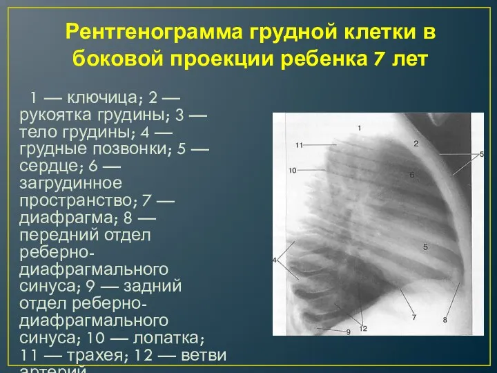 Рентгенограмма грудной клетки в боковой проекции ребенка 7 лет 1