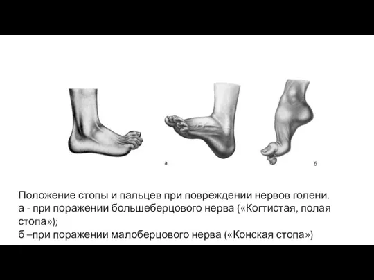 Положение стопы и пальцев при повреждении нервов голени. а -