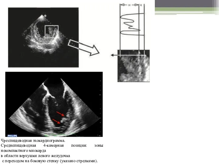 Чреспищеводная эхокардиограмма. Среднепищеводная 4-камерная позиция: зоны некомпактного миокарда в области верхушки левого желудочка