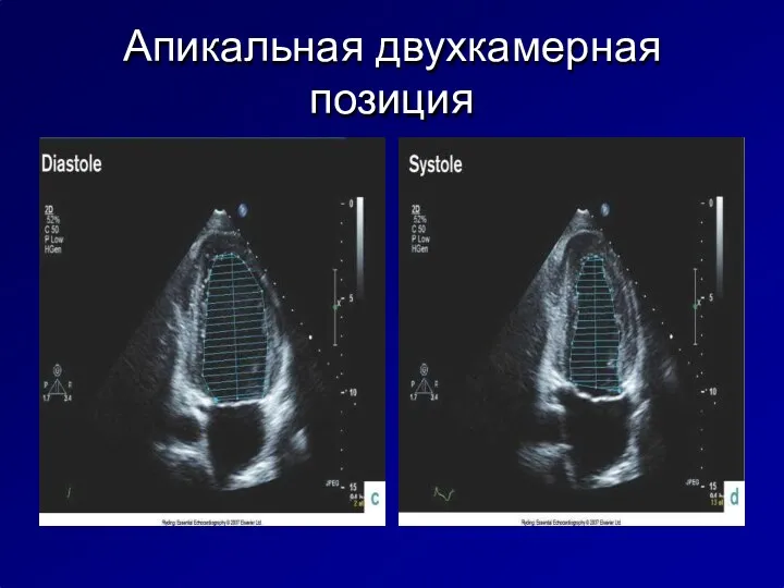 Апикальная двухкамерная позиция