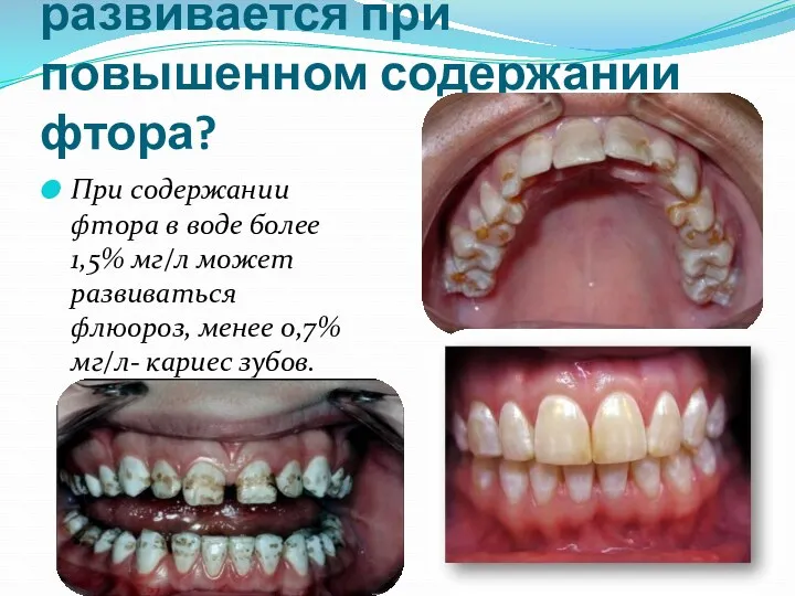 Какое заболевание развивается при повышенном содержании фтора? При содержании фтора