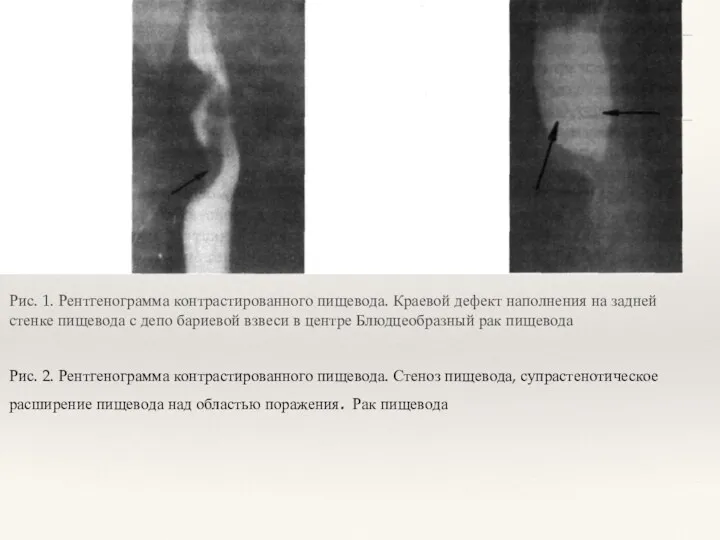 Рис. 1. Рентгенограмма контрастированного пищевода. Краевой дефект наполнения на задней