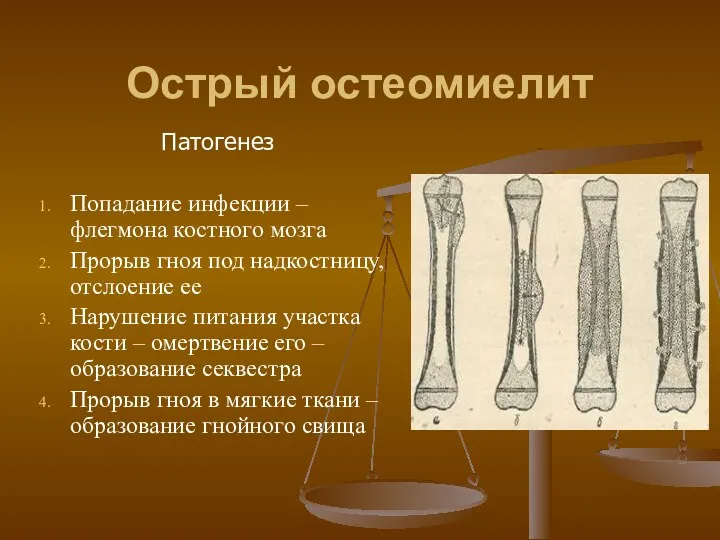 Острый остеомиелит Патогенез Попадание инфекции – флегмона костного мозга Прорыв