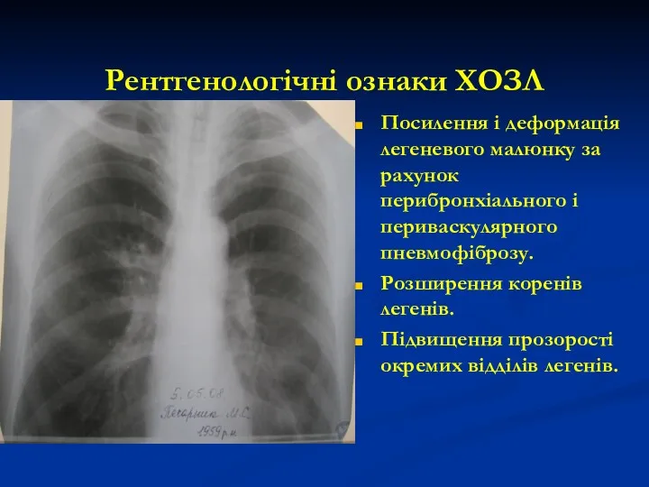 Рентгенологічні ознаки ХОЗЛ Посилення і деформація легеневого малюнку за рахунок