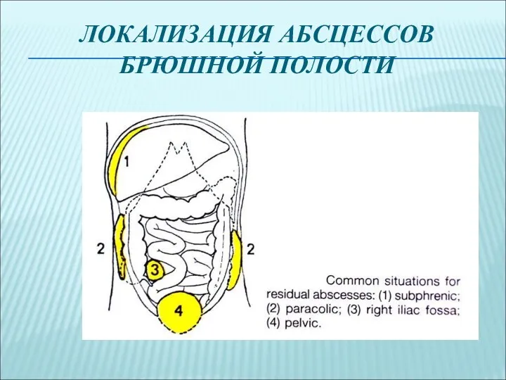 ЛОКАЛИЗАЦИЯ АБСЦЕССОВ БРЮШНОЙ ПОЛОСТИ