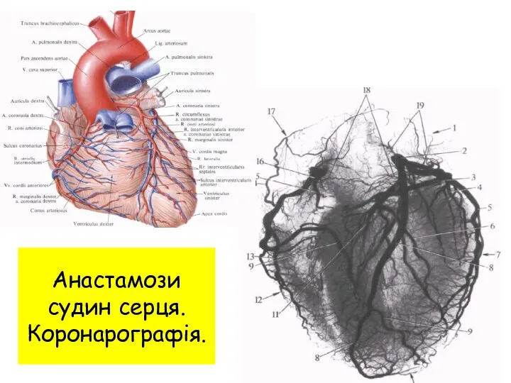 Анастамози судин серця. Коронарографія.