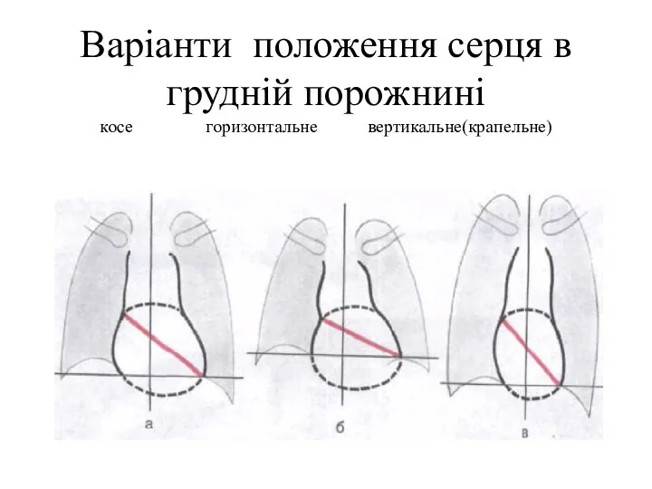 Варіанти положення серця в грудній порожнині косе горизонтальне вертикальне(крапельне)