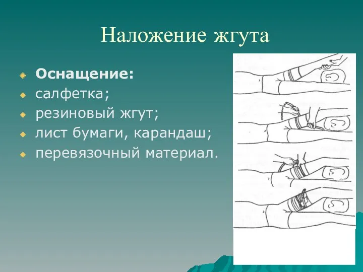 Наложение жгута Оснащение: салфетка; резиновый жгут; лист бумаги, карандаш; перевязочный материал.