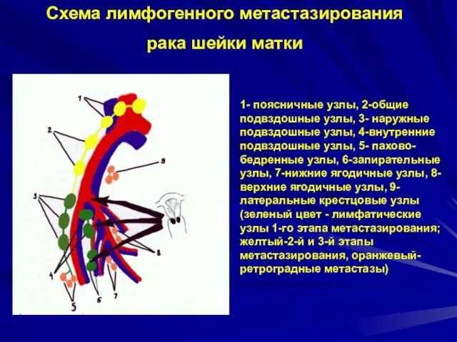 Схема лимфогенного метастазирования рака шейки матки 1- поясничные узлы, 2-общие