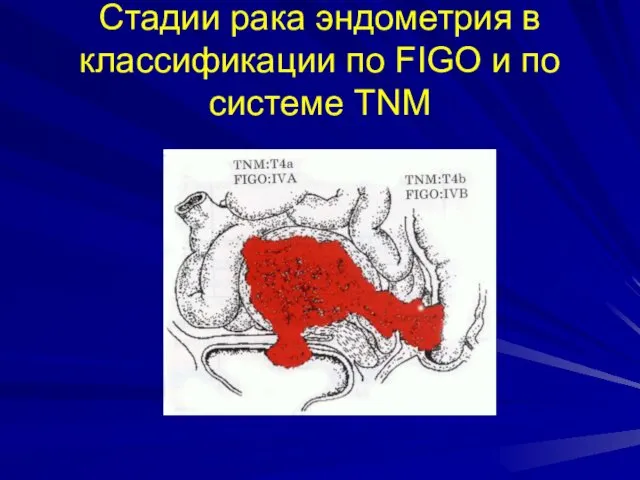 Стадии рака эндометрия в классификации по FIGO и по системе TNM