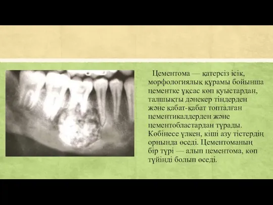 Цементома — қатерсіз ісік, морфологиялық құрамы бойынша цементке ұқсас көп