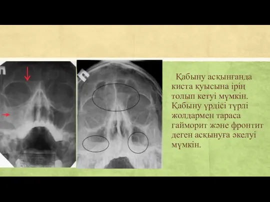 Қабыну асқынғанда киста қуысына ірің толып кетуі мүмкін. Қабыну үрдісі