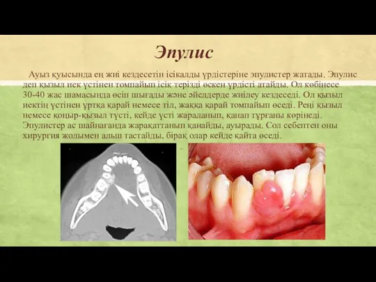 Эпулис Ауыз қуысында ең жиі кездесетін ісікалды үрдістеріне эпулистер жатады.