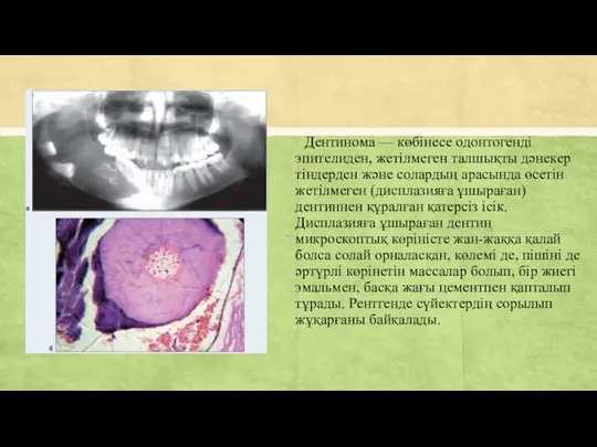 Дентинома — көбінесе одонтогенді эпителиден, жетілмеген талшықты дәнекер тіндерден және