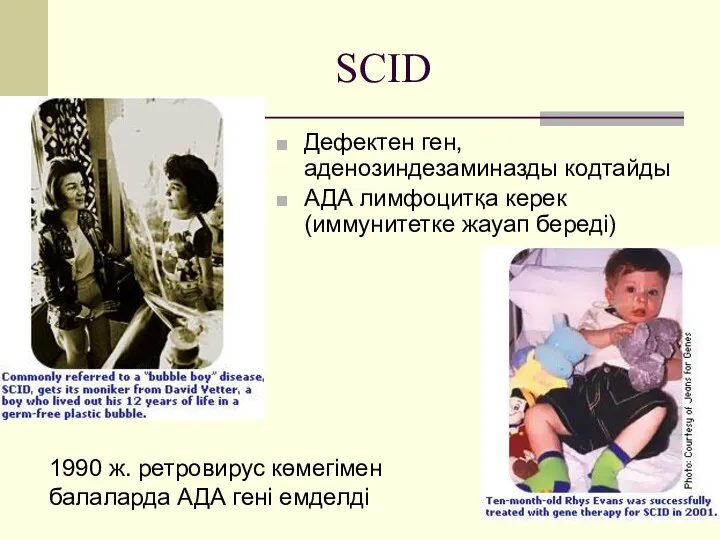 SCID Дефектен ген, аденозиндезаминазды кодтайды АДА лимфоцитқа керек (иммунитетке жауап береді) 1990 ж.
