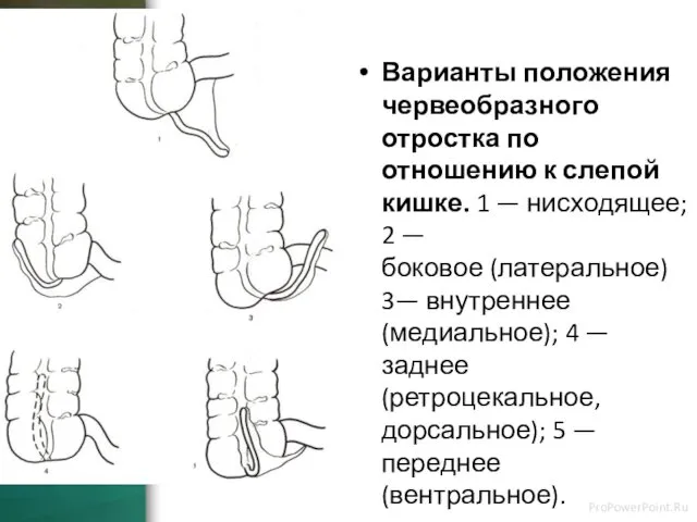 Варианты положения червеобразного отростка по отношению к слепой кишке. 1