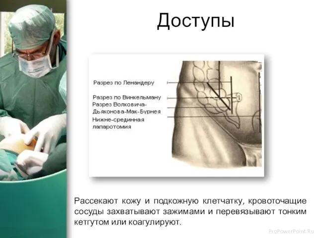 Доступы Рассекают кожу и подкожную клетчатку, кровоточащие сосуды захватывают зажимами и перевязывают тонким кетгутом или коагулируют.