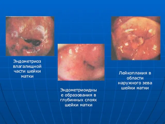 Эндометриоз влагалищной части шейки матки Эндометриоидные образования в глубинных слоях
