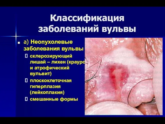 Классификация заболеваний вульвы а) Неопухолевые заболевания вульвы склерозирующий лишай –