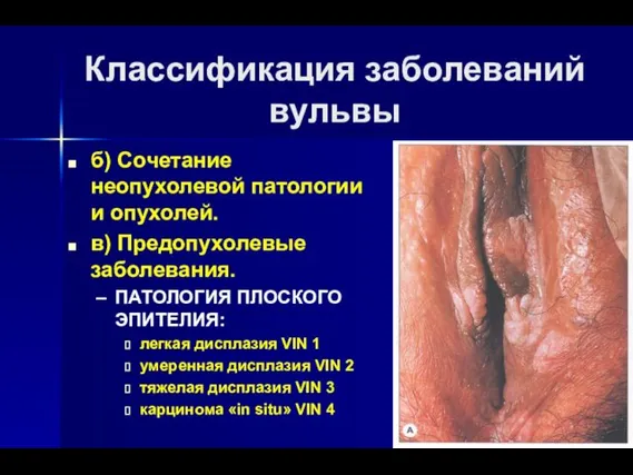 Классификация заболеваний вульвы б) Сочетание неопухолевой патологии и опухолей. в)