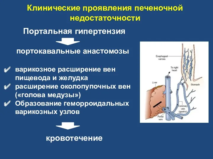 Клинические проявления печеночной недостаточности Портальная гипертензия портокавальные анастомозы варикозное расширение