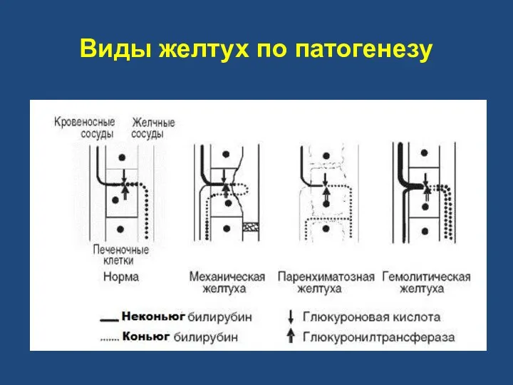 Виды желтух по патогенезу