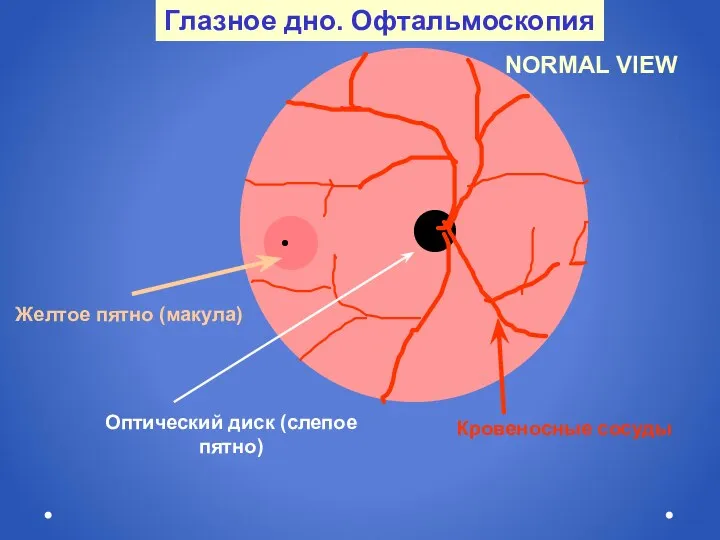 Глазное дно. Офтальмоскопия NORMAL VIEW Кровеносные сосуды Оптический диск (слепое пятно) Желтое пятно (макула)
