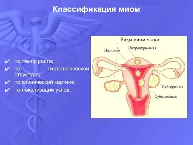 Классификация миом по темпу роста; по гистологической структуре; по клинической картине; по локализации узлов.