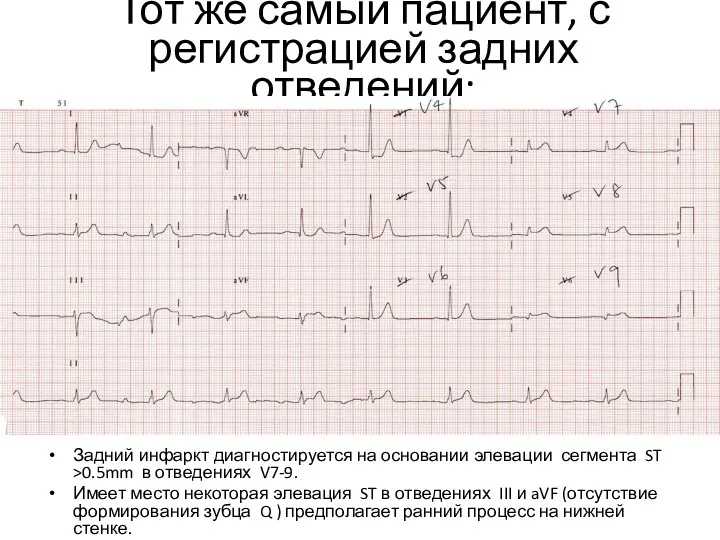 Тот же самый пациент, с регистрацией задних отведений: Задний инфаркт