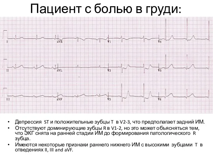 Пациент с болью в груди: Депрессия ST и положительные зубцы