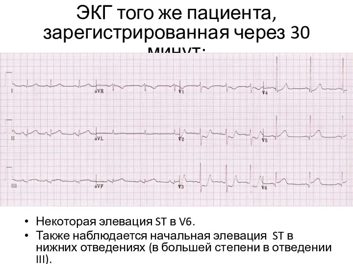 ЭКГ того же пациента, зарегистрированная через 30 минут: Некоторая элевация