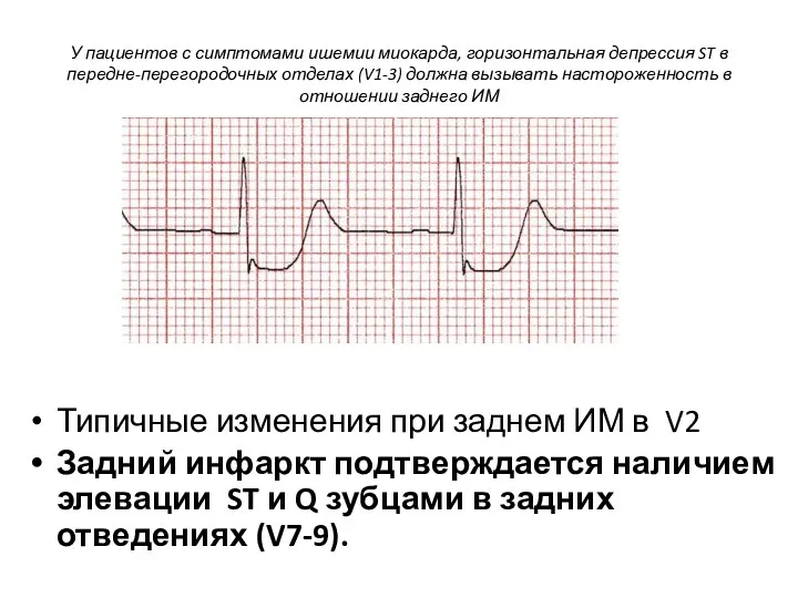 У пациентов с симптомами ишемии миокарда, горизонтальная депрессия ST в