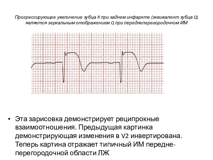 Прогрессирующее увеличение зубца R при заднем инфаркте (эквивалент зубца Q)