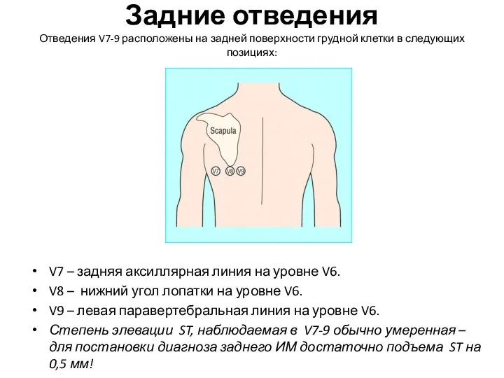 Задние отведения Отведения V7-9 расположены на задней поверхности грудной клетки