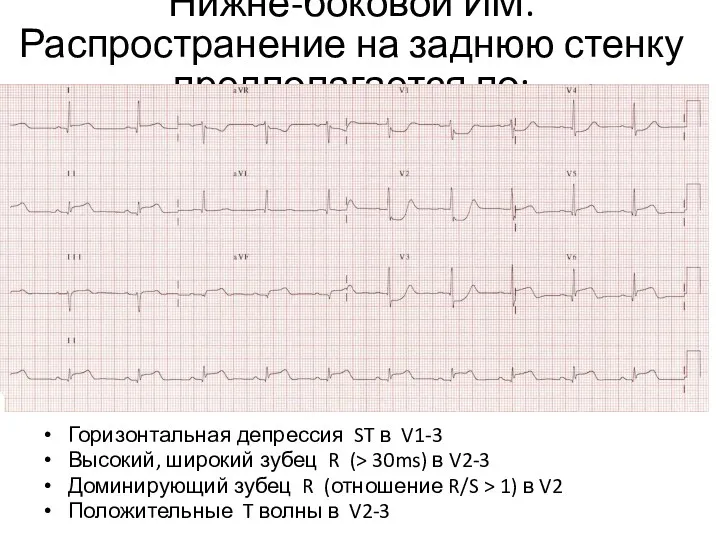 Нижне-боковой ИМ. Распространение на заднюю стенку предполагается по: Горизонтальная депрессия