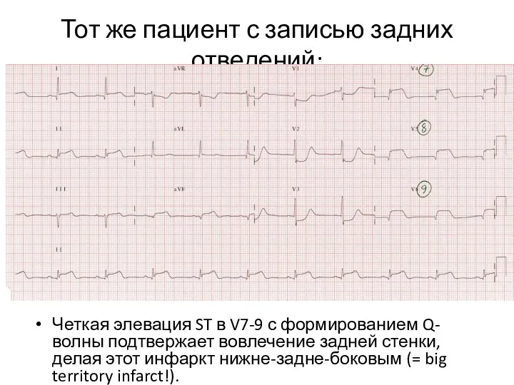 Тот же пациент с записью задних отведений: Четкая элевация ST