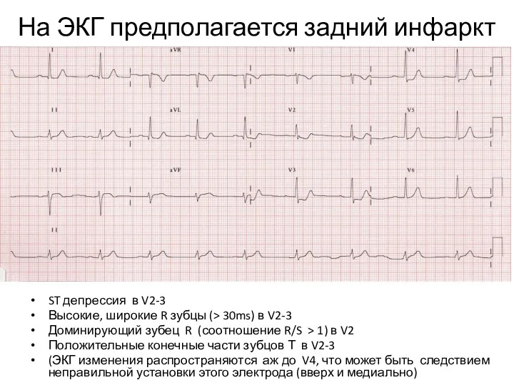 На ЭКГ предполагается задний инфаркт ST депрессия в V2-3 Высокие,