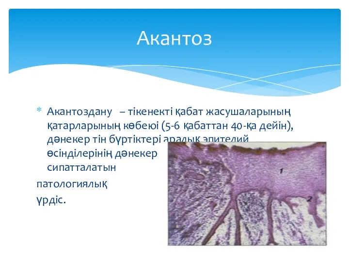 Акантоздану – тікенекті қабат жасушаларының қатарларының көбеюі (5-6 қабаттан 40-қа дейін), дәнекер тін