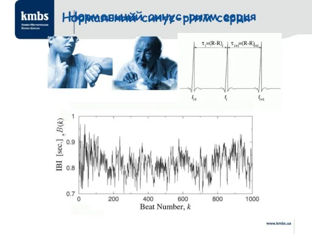 Нормальний синус-ритм серця Нормальний синус-ритм серця