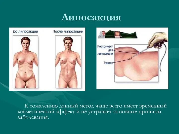 Липосакция К сожалению данный метод чаще всего имеет временный косметический