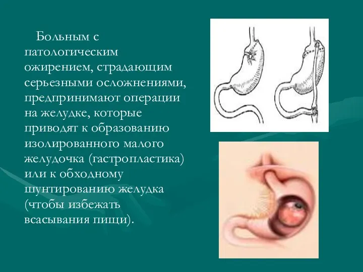 Больным с патологическим ожирением, страдающим серьезными осложнениями, предпринимают операции на