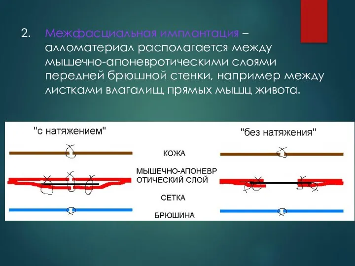 2. Межфасциальная имплантация – алломатериал располагается между мышечно-апоневротическими слоями передней брюшной стенки, например