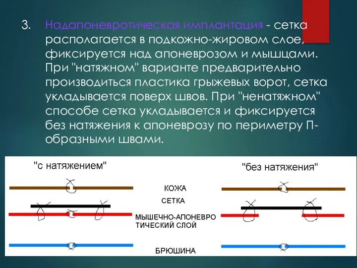 3. Надапоневротическая имплантация - сетка располагается в подкожно-жировом слое, фиксируется