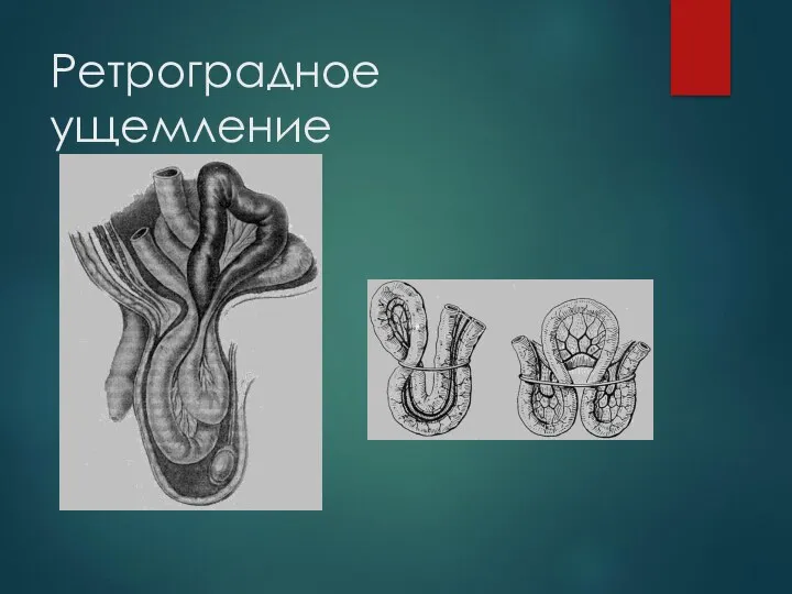 Ретроградное ущемление