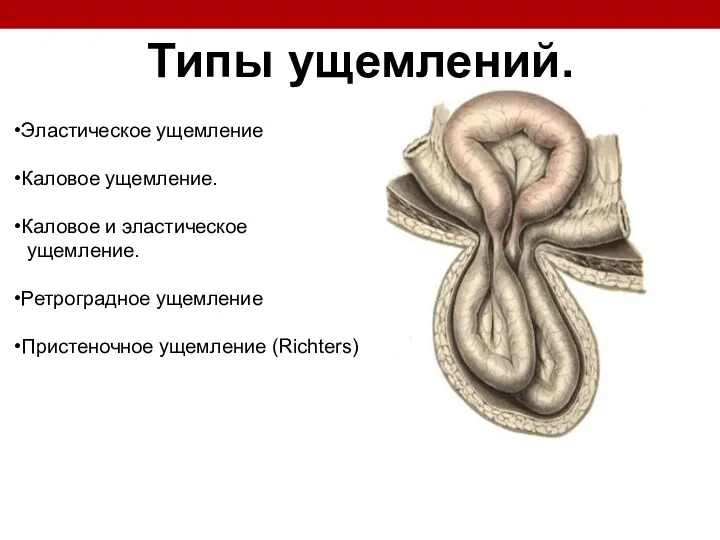 Типы ущемлений. Эластическое ущемление Каловое ущемление. Каловое и эластическое ущемление. Ретроградное ущемление Пристеночное ущемление (Richters)