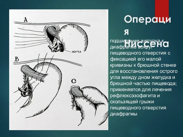 Операция Ниссена подшивание желудка к диафрагме вокруг пищеводного отверстия с